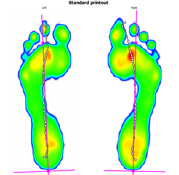 image of barefoot walking with some small red hotspots.